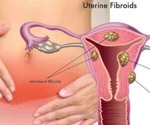 Miracle traditionnel : traitement 100% efficace des fibromes utérins.