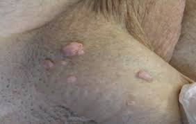 Comment soigner des condylomes?