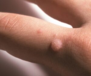 Qu&rsquo;est-ce que les condylomes et comment soigner des condylomes?