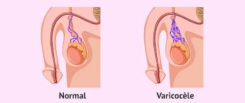 Traitement naturel de la varicocèle à base de plantes: